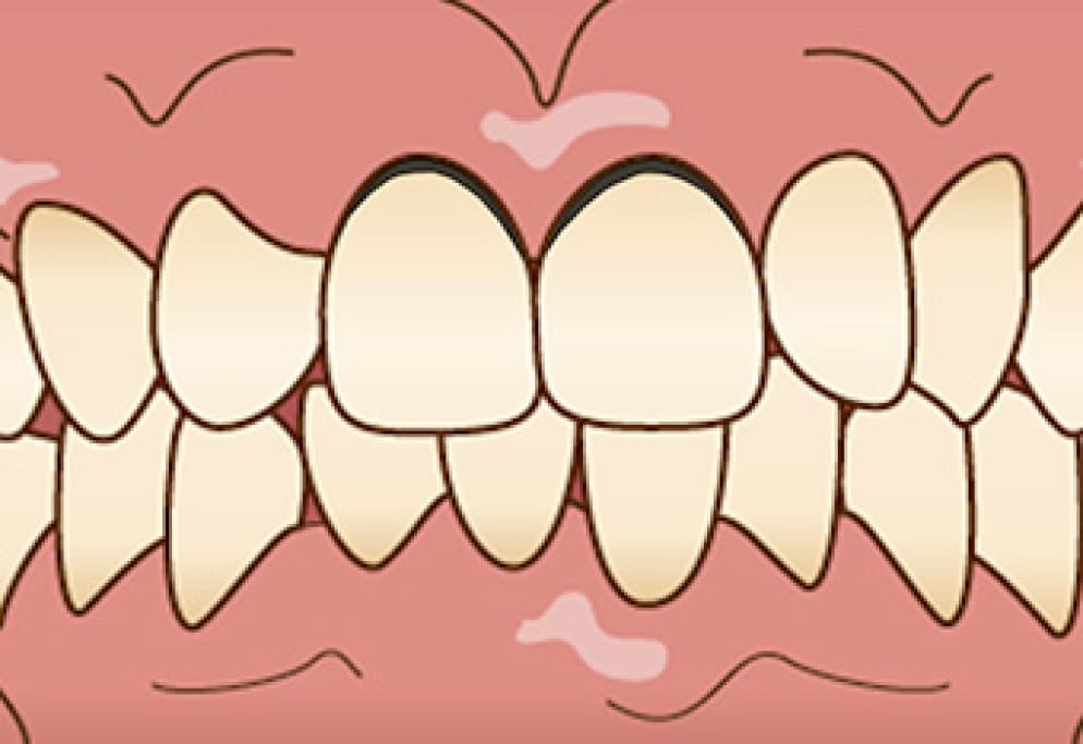 かぶせ物と歯ぐきの間の隙間