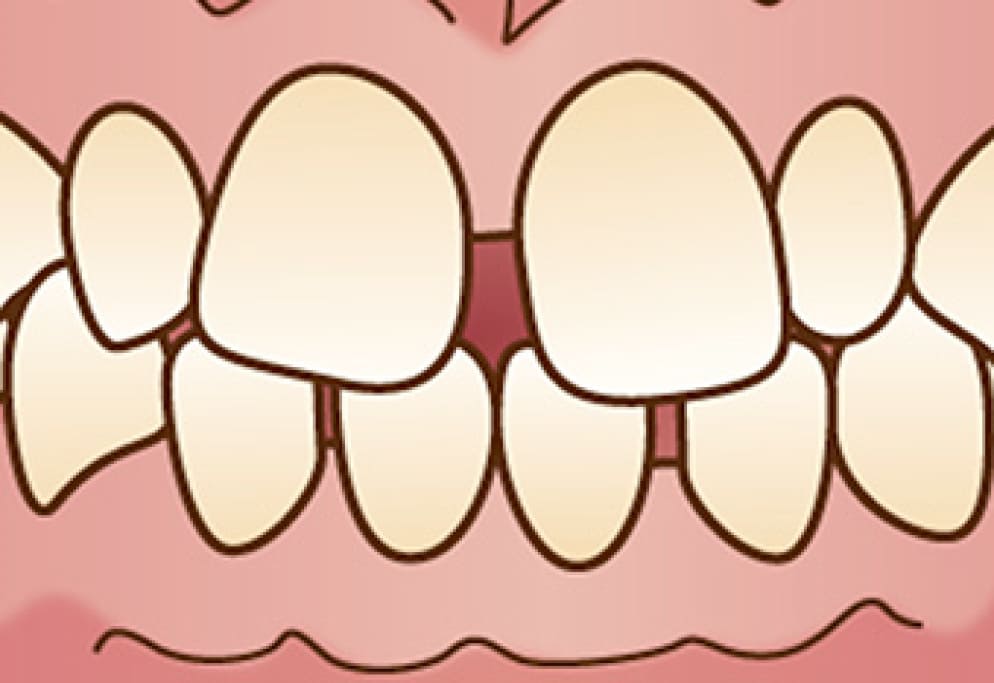 前歯の形や歯ならびが不自然